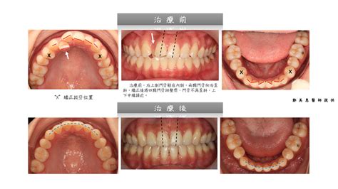 門牙歪面相